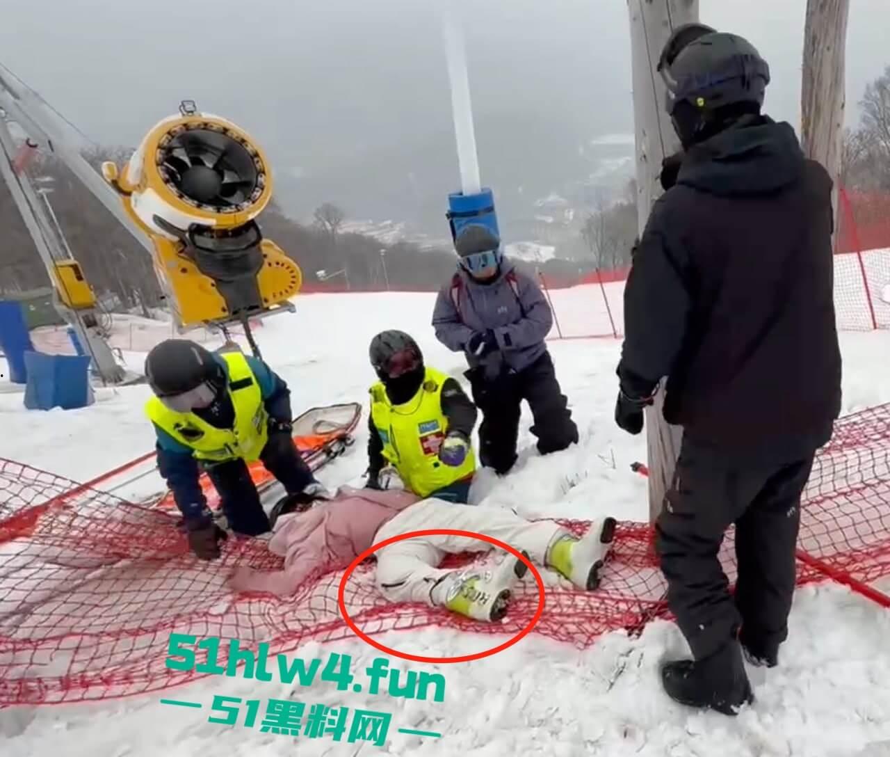 北大湖滑雪场新手滑雪妹,误入中高级滑道滑雪,不慎摔飞被撞到变形断腿场面超吓人。 第2张 北大湖滑雪场新手滑雪妹,误入中高级滑道滑雪,不慎摔飞被撞到变形断腿场面超吓人。 第2张